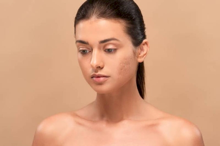 Rajeunissement par le Potenza : microneedling radiofréquence pour une peau liftée au Centre Médical Okapi prés de Hyères dans le 83
