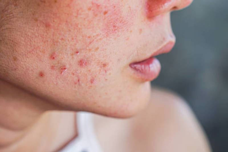 Traitement de l'acné inflammatoire par IPL au Centre Medical Esthétique Okapi à Pierrefeu du Var prés de Hyères