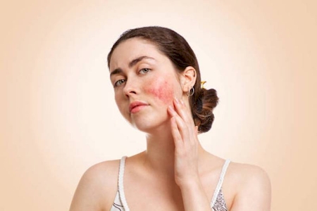 Nos Traitements Vasculaire par Laser et IPL au Centre Medical Esthétique Okapi à Pierrefeu du Var 83390