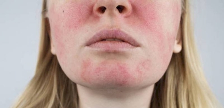 Elimination des tâches rouges du visage et du corps par laser Nd:YAG