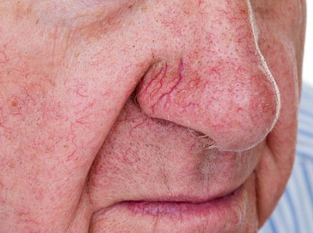 Elimination des tâches rouges du visage et du corps par laser Nd:YAG