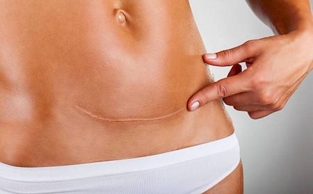 Traitement par Microneedling Radiofréquencé - le POTENZA  des cicatrices et vergetures au Centre Medical Okapi à Pierrefeu-du-Var
